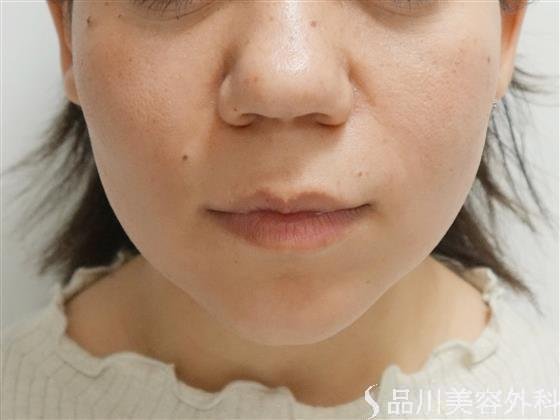 症例NO.41751のAFTER写真