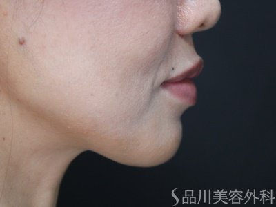 症例NO.75067のBEFORE写真