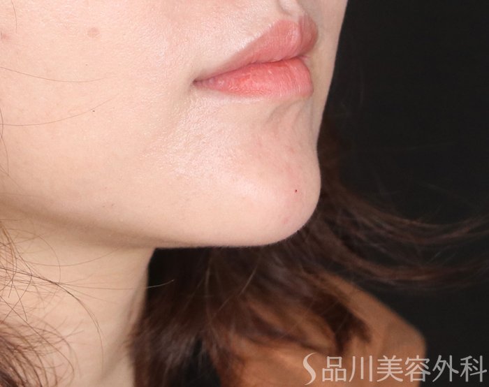 症例NO.72266のAFTER写真