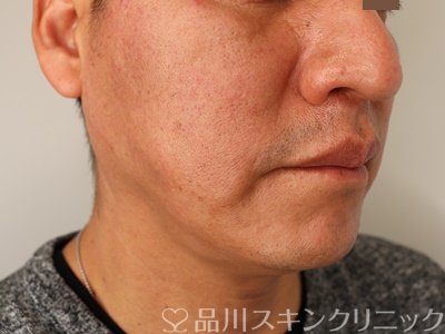 症例NO.62580のBEFORE写真