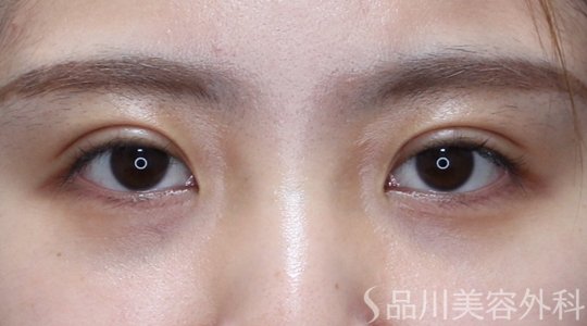 症例NO.71720のAFTER写真