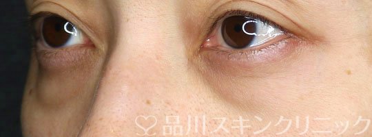 症例NO.75132のBEFORE写真