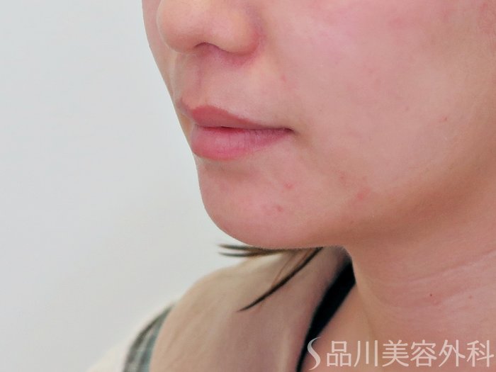 症例NO.69716のBEFORE写真