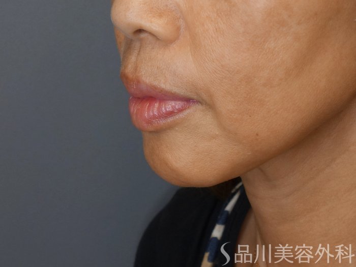症例NO.71308のBEFORE写真