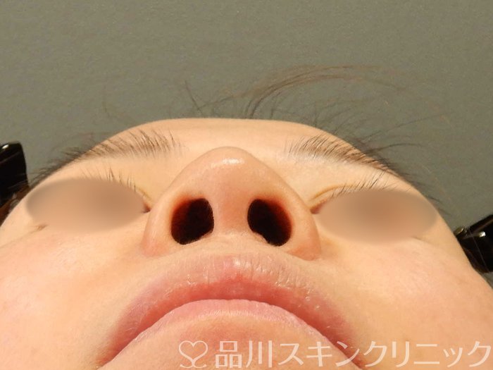 症例NO.62585のBEFORE写真