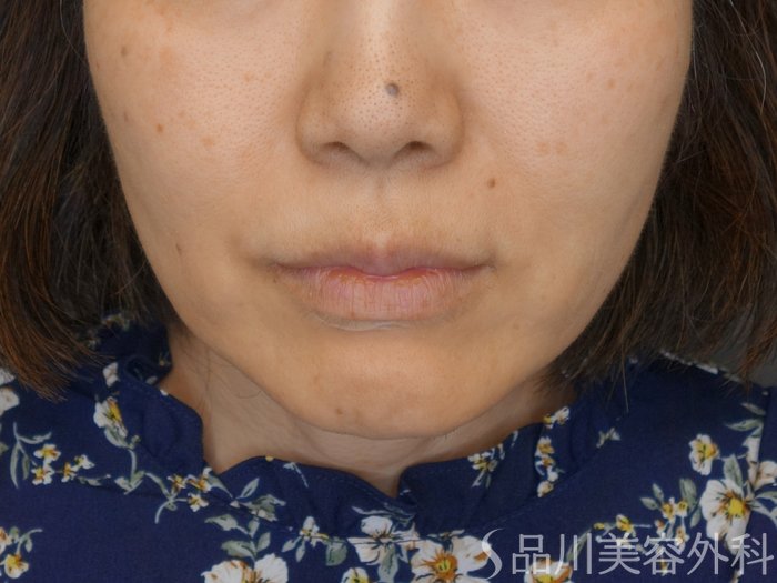 症例NO.70853のBEFORE写真