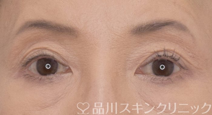 症例NO.69556のAFTER写真
