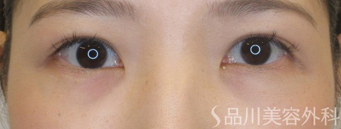 症例NO.70934のAFTER写真