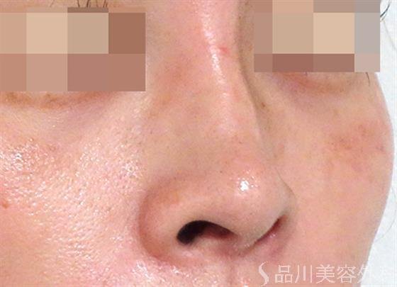 症例NO.27474のBEFORE写真