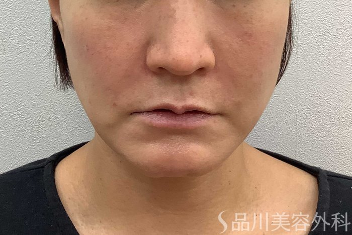 症例NO.62066のAFTER写真