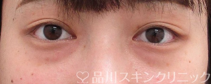 症例NO.64195のBEFORE写真