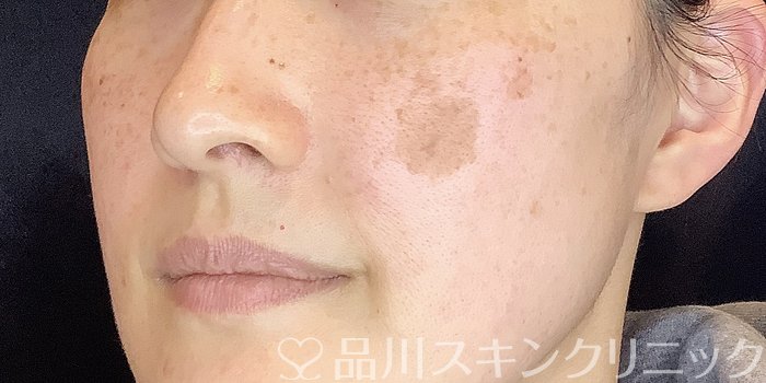 症例NO.70747のBEFORE写真