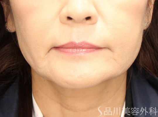 症例NO.70228のAFTER写真
