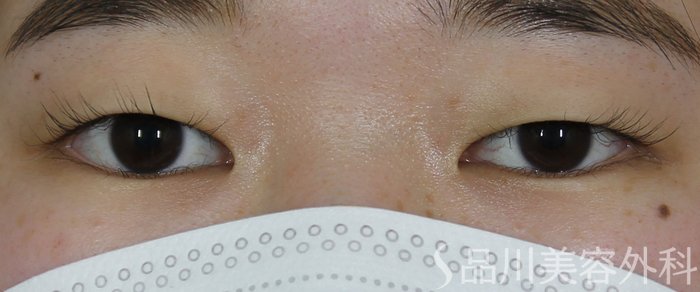 症例NO.70719のBEFORE写真