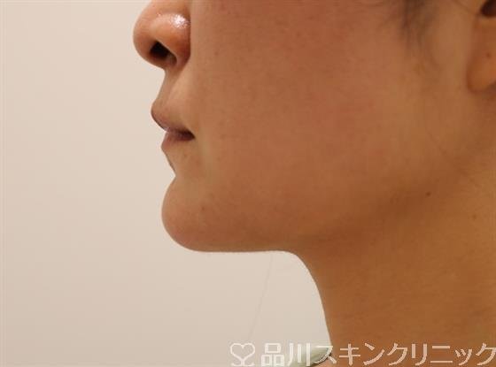 症例NO.42480のAFTER写真
