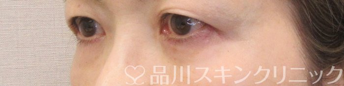 症例NO.70908のAFTER写真