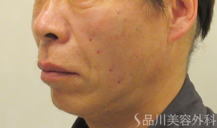 症例NO.73296のAFTER写真