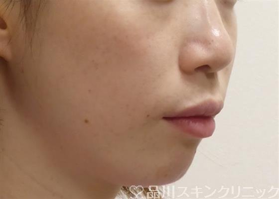 症例NO.32237のAFTER写真