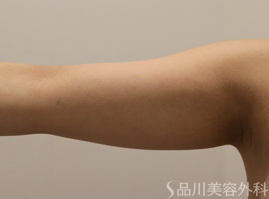 症例NO.72755のBEFORE写真