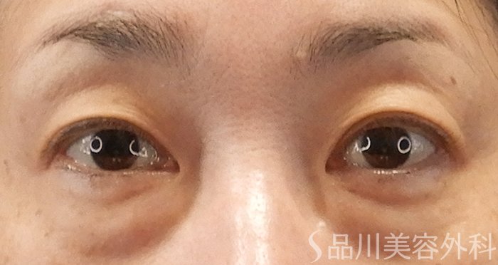 症例NO.70973のBEFORE写真