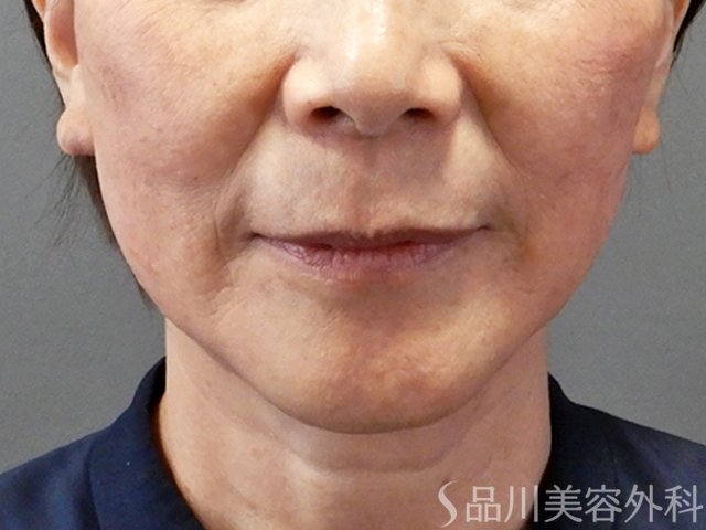 症例NO.70431のAFTER写真