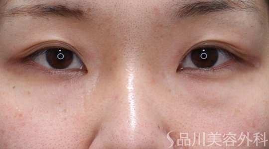 症例NO.69599のBEFORE写真