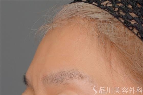 症例NO.54764のBEFORE写真