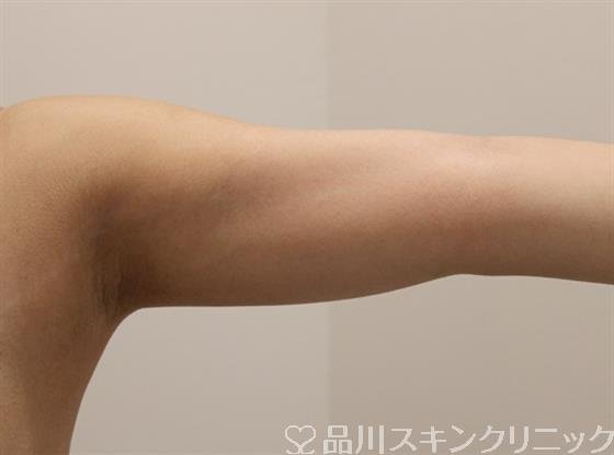 症例NO.46544のBEFORE写真