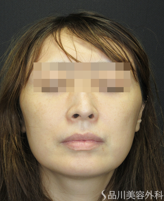症例NO.72122のBEFORE写真