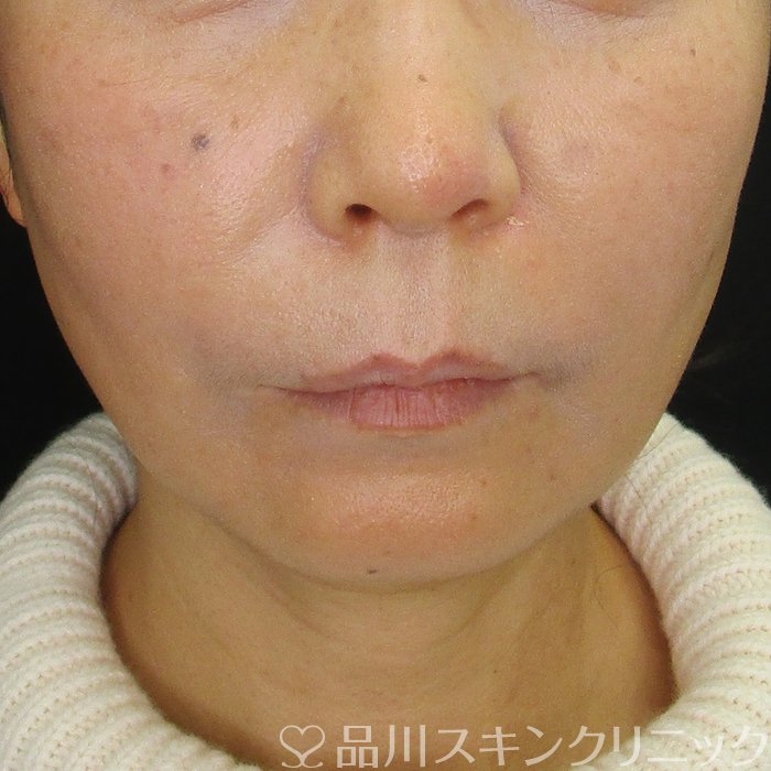 症例NO.73579のBEFORE写真