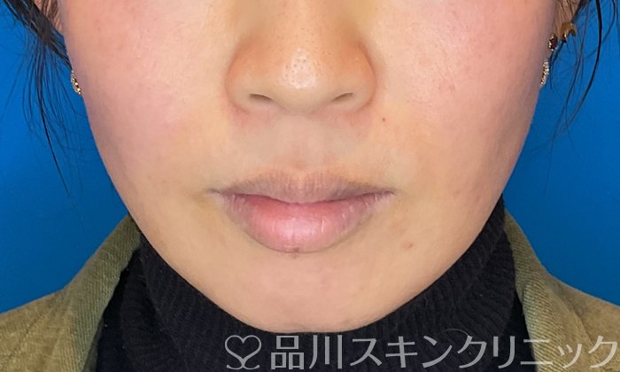 症例NO.74828のBEFORE写真
