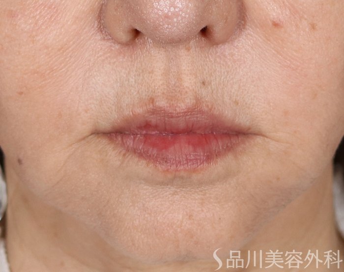 症例NO.70885のBEFORE写真