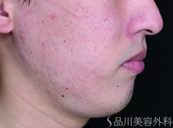 症例NO.73494のBEFORE写真