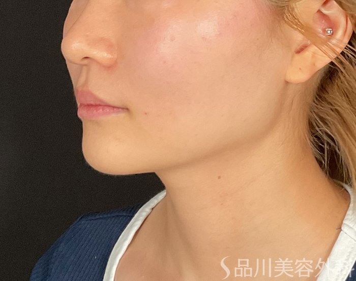 症例NO.74508のAFTER写真