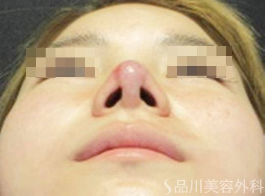 症例NO.74088のAFTER写真