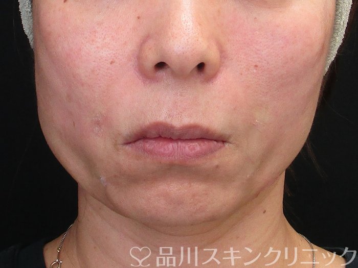 症例NO.72922のAFTER写真