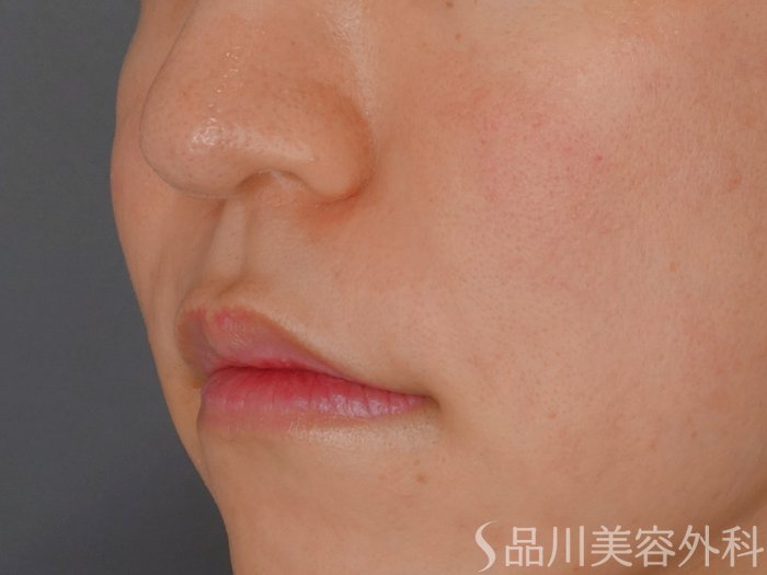 症例NO.72156のAFTER写真