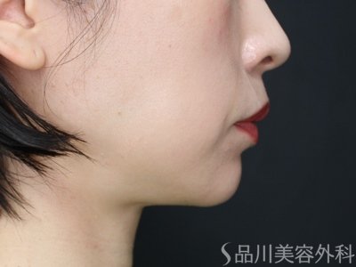 症例NO.74102のBEFORE写真