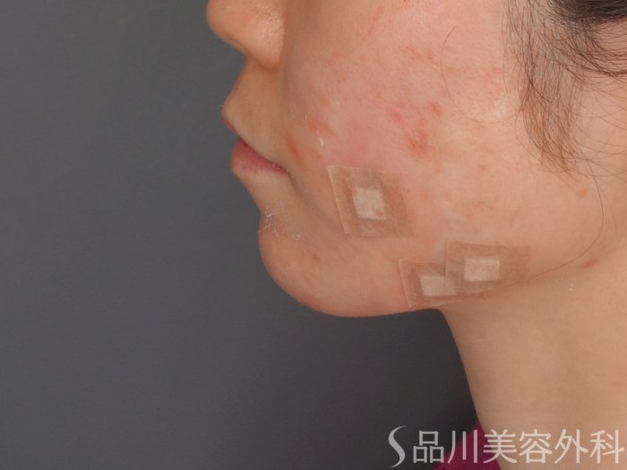 症例NO.62248のBEFORE写真