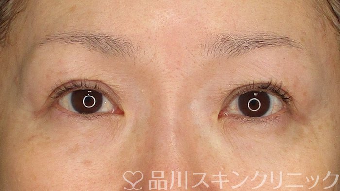 症例NO.73352のAFTER写真