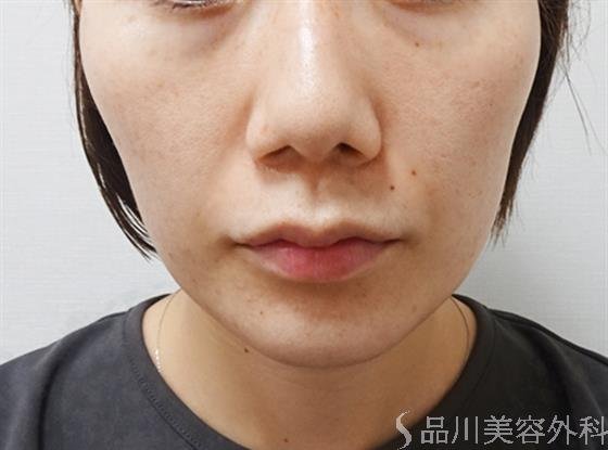 症例NO.51905のAFTER写真