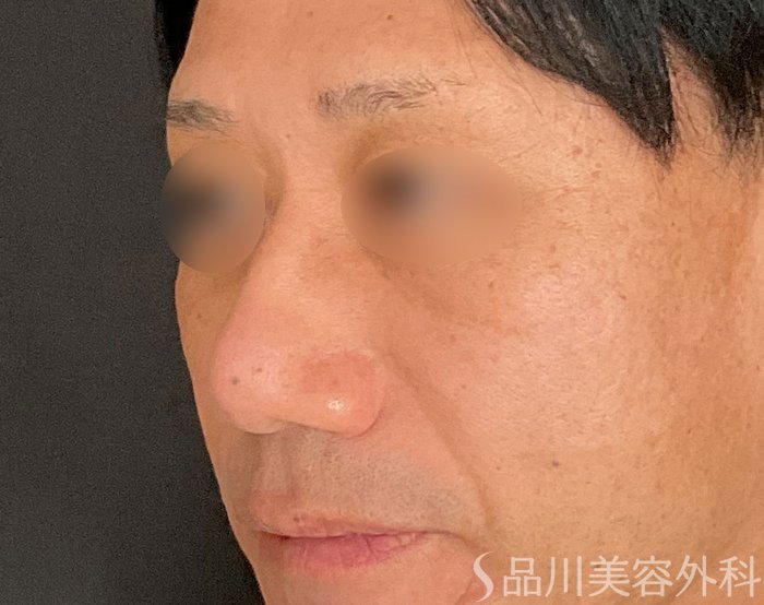 症例NO.74718のAFTER写真