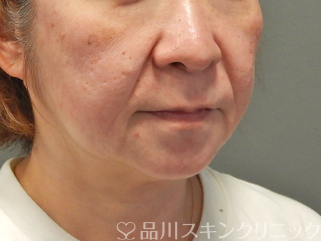 症例NO.75056のBEFORE写真