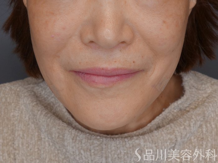 症例NO.72771のAFTER写真