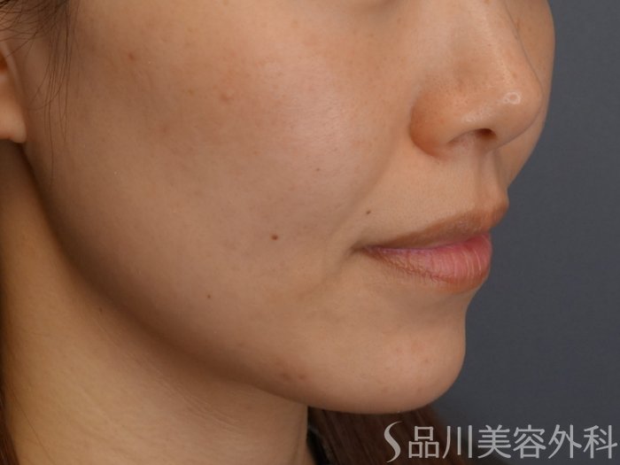 症例NO.73928のBEFORE写真
