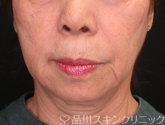 症例NO.75177のBEFORE写真