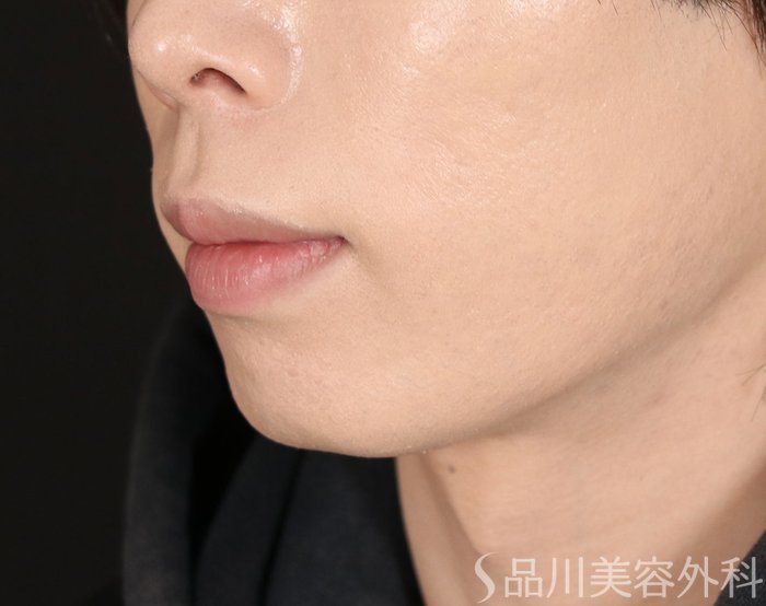 症例NO.72410のBEFORE写真