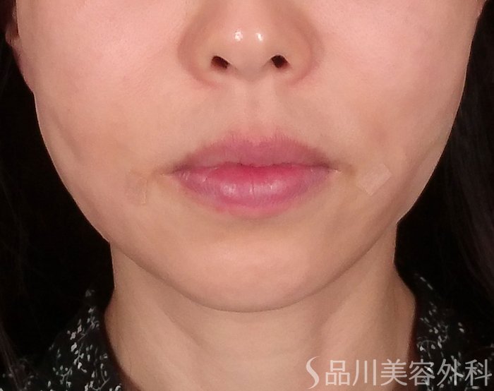 症例NO.69314のAFTER写真