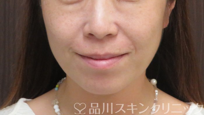 症例NO.72170のBEFORE写真