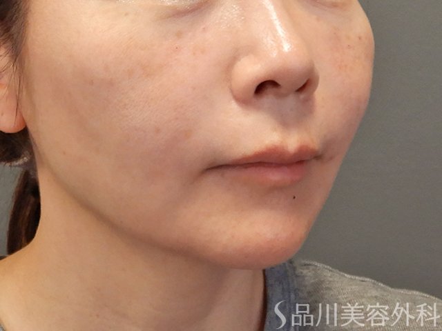 症例NO.74471のAFTER写真